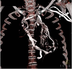 SVC Occlusion With Collaterals - CTisus CT Scan