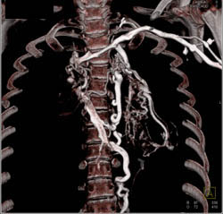 SVC Occlusion With Collaterals - CTisus CT Scan