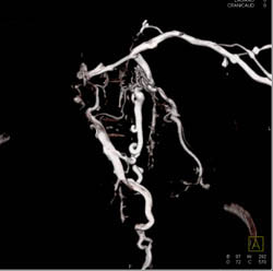 SVC Occlusion With Collaterals - CTisus CT Scan