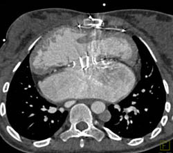 Av Shunt as Bypass - CTisus CT Scan