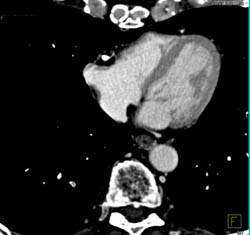 RCA Disease - CTisus CT Scan