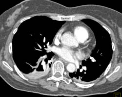 Pulmonary Embolism - CTisus CT Scan