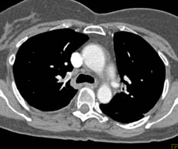 Pulmonary Embolism - CTisus CT Scan