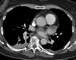 Pulmonary Embolism - CTisus CT Scan