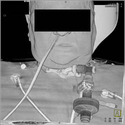 3D of Ng Tube and Tracheostomy - CTisus CT Scan