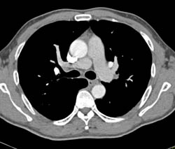 Pulmonary Embolism - CTisus CT Scan