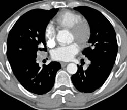 Pulmonary Embolism - CTisus CT Scan