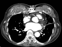 Guiana Worms in Chest Wall - CTisus CT Scan