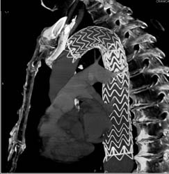 Stent in Arch to Repair Aneurysm - CTisus CT Scan