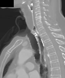 Surgical Connection of Esophagus to Trachea - CTisus CT Scan