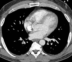 Pulmonary Embolism - CTisus CT Scan