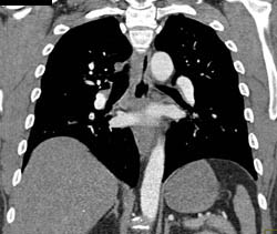 Pulmonary Embolism - CTisus CT Scan