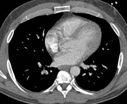 Pulmonary Embolism - CTisus CT Scan