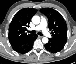 Pulmonary Embolism - CTisus CT Scan