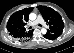 SVC Occlusion With Collaterals - CTisus CT Scan