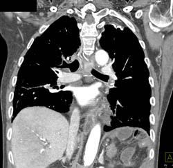 SVC Occlusion With Collaterals - CTisus CT Scan