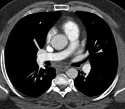 Pulmonary Embolism - CTisus CT Scan