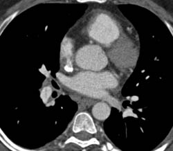 Pulmonary Embolism - CTisus CT Scan