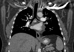 Pulmonary Embolism - CTisus CT Scan