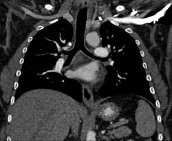 Pulmonary Embolism - CTisus CT Scan