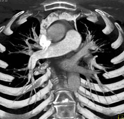 Pulmonary Embolism - CTisus CT Scan