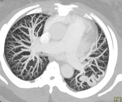 Pulmonary Arteriovenous Malformation (PAVM) - CTisus CT Scan