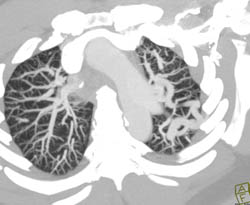 Pulmonary Arteriovenous Malformation (PAVM) - CTisus CT Scan