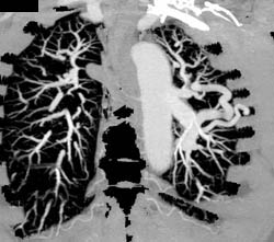 Pulmonary Arteriovenous Malformation (PAVM) - CTisus CT Scan