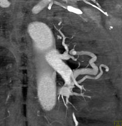 Pulmonary Arteriovenous Malformation (PAVM) - CTisus CT Scan