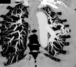 Pulmonary Arteriovenous Malformation (PAVM) - CTisus CT Scan