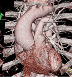 Dilated Aortic Root and Ascending Aorta - CTisus CT Scan