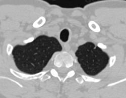 Thickening of Tracheal Wall in Wegener's Granulomatosis - CTisus CT Scan