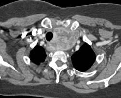 Goiter Extends to Posterior Mediastinum - CTisus CT Scan