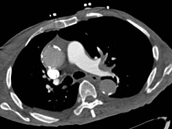 Pulmonary Embolism - CTisus CT Scan