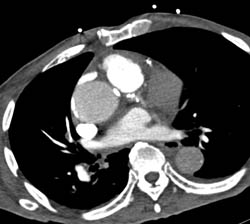 Pulmonary Embolism - CTisus CT Scan