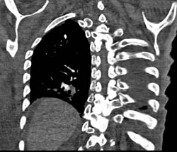 Pulmonary Embolism - CTisus CT Scan