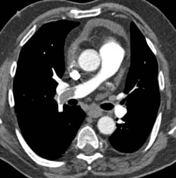 Pulmonary Embolism - CTisus CT Scan