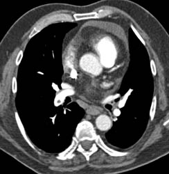 Pulmonary Embolism - CTisus CT Scan