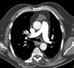 Pulmonary Embolism - CTisus CT Scan