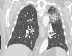 Pulmonary Embolism - CTisus CT Scan