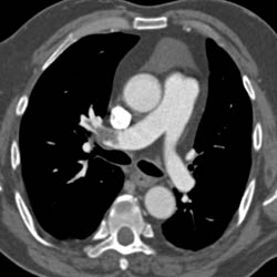 Pulmonary Embolism - CTisus CT Scan