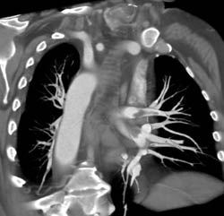 Pulmonary Embolism - CTisus CT Scan