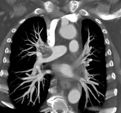 Pulmonary Embolism - CTisus CT Scan