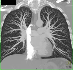 Pulmonary Embolism - CTisus CT Scan