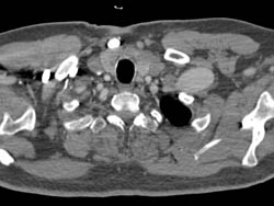 Axillary Artery Aneurysm - CTisus CT Scan