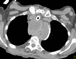 Posterior Mediastinal Abscess Following Biopsy - CTisus CT Scan