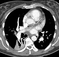 Pulmonary Embolism With Infarct - CTisus CT Scan