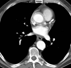 Pulmonary Embolism- Right Lower Lobe - CTisus CT Scan