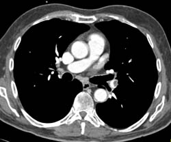 Pulmonary Embolism- Left - CTisus CT Scan