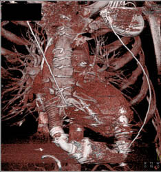 Patent Bypass Grafts - CTisus CT Scan